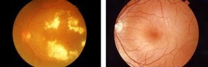 diabetic retinopathy eye 680x220