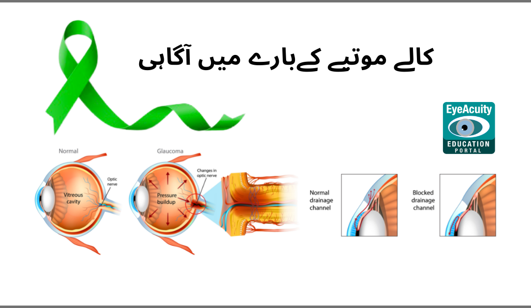Glaucoma Awareness in Urdu
